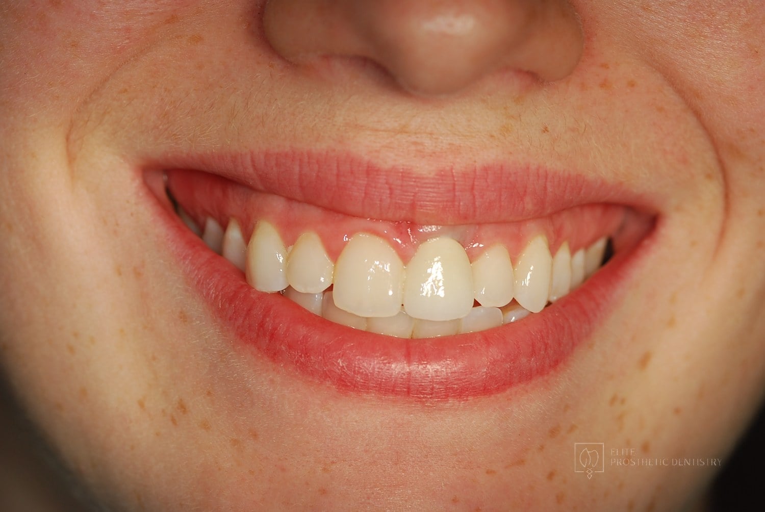 Smile after a missing front tooth was restored with a dental implant
