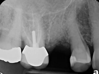 bone graft dental implant Bethesda