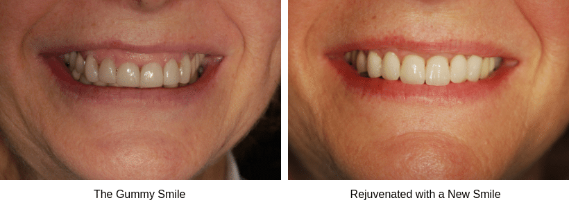 ultimate smile makeover before & after