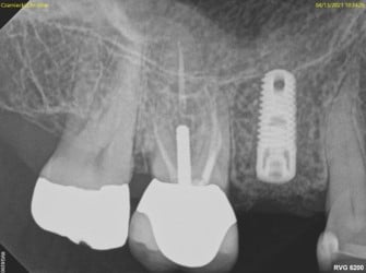 dental implant Washington DC