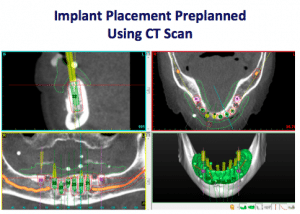 Implant-Placement-Preplanned-Using-CT-Scan-1