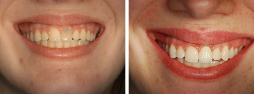 before and after dental implant restoration Bethesda