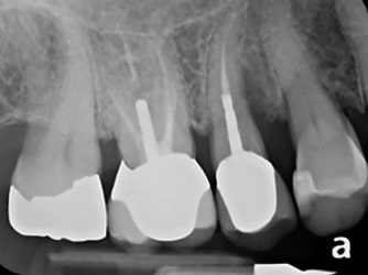 bone loss dental implant Bethesda
