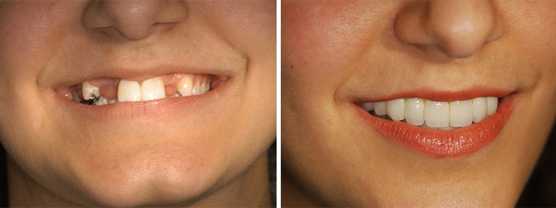 dental implants before & after