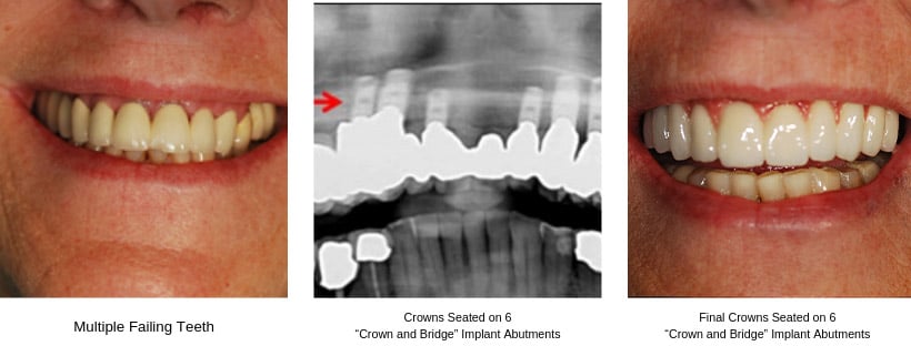 crown and bridge implant abutments before & after