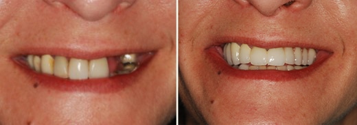 smile makeover before & after