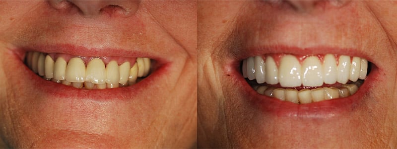 full arch implant before & after