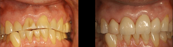 Repairing-the-Worn-Out-Dentition-bottom