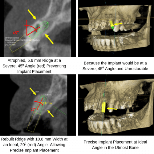 bone graft for implant placement Washington DC