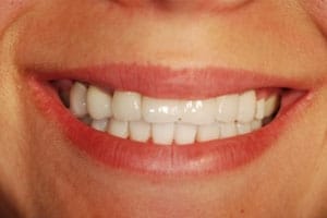 Dental Implants Supporting a Cosmetic Smile Makeover