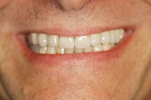 Dental Implant Supported Makeover with Crowns