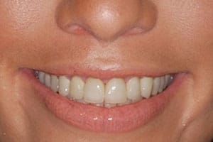 Cosmetic Dentistry Case