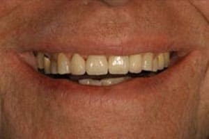 Repairing the Worn Out Dentition