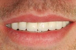Tooth Enamel Erosion & Treatment