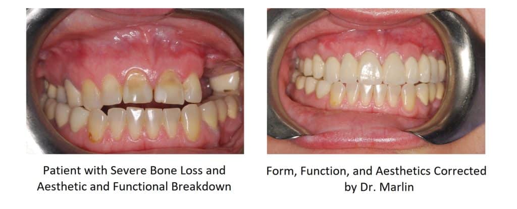 bone-loss-before-and-after