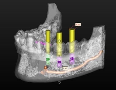 full arch implant diagram 3D