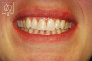 crown front tooth restoration patient