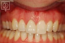 crown front tooth restoration patient
