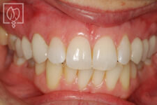 redesigning tooth shape & color patient