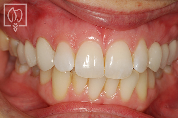 redesigning tooth shape & color patient