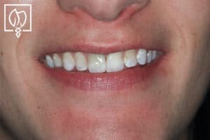 dental-crown-smile-makeovers-discolored-teeth-transformations-dental-crowns-severely-discolored-dentition--4916