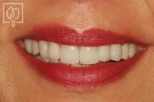 dental-crown-smile-makeovers-discolored-teeth-transformations-dental-crowns-severely-discolored-dentition--7738