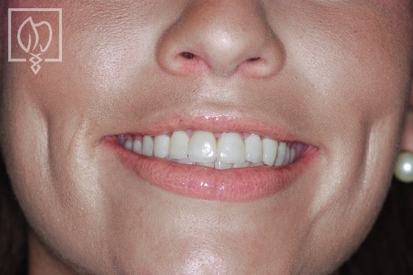 dental-crown-smile-makeovers-worn-down-teeth-makeovers-dental-crowns-severely-worn-dentition--4650