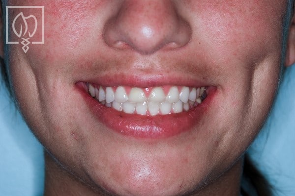 dental-crown-smile-makeovers-worn-down-teeth-makeovers-dental-crowns-severely-worn-dentition--4652
