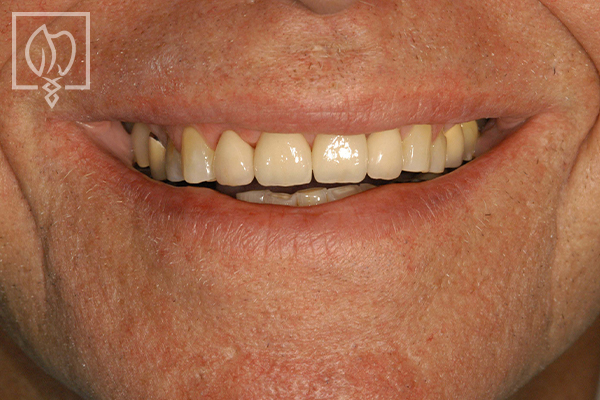 severely worn dentition patient