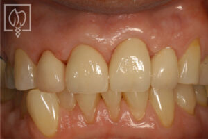 severely worn dentition patient