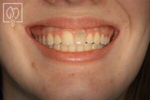 front tooth replacement with implant patient