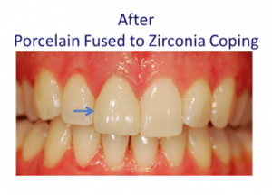 porcelain fused to zirconia coping patient