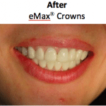eMax Crown patient