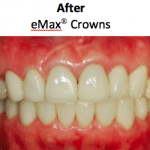 eMax Crown patient