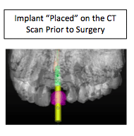ct guided implant diagram