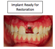 anterior implant restoration patient