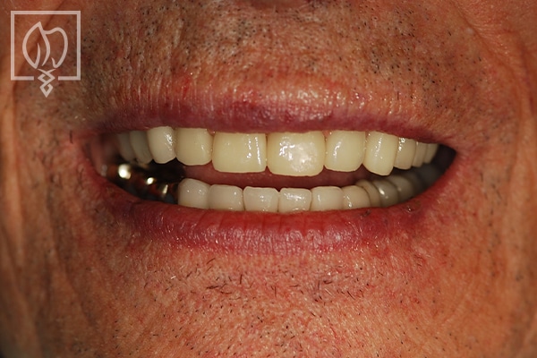 salvaging full mouth implant reconstruction patient