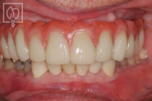 salvaging full mouth implant reconstruction patient