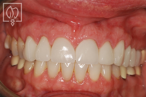 front tooth gap repair patient