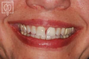 front tooth gap repair patient