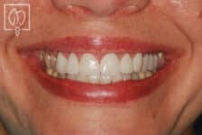 smile-design-diastema-tooth-gap-reduction-makeovers-dental-crowns--4593