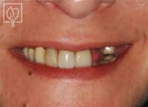 Teeth implants before and after photos