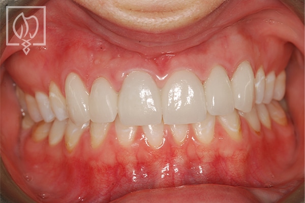 rejuvenating-severely-mottled-discolored-teeth--1776
