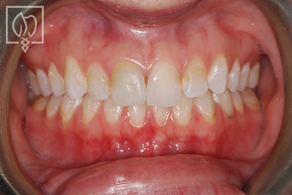 rejuvenating-severely-mottled-discolored-teeth--1779