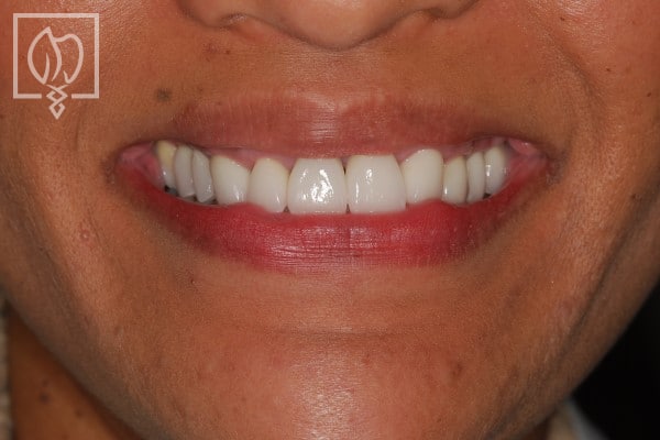 Gummy Smile Before After Gallery Bethesda
