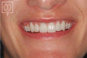 rejuvenating-severely-mottled-discolored-teeth-dental-crowns-severely-discolored-dentition--1777