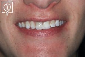 rejuvenating-severely-mottled-discolored-teeth-dental-crowns-severely-discolored-dentition--4916