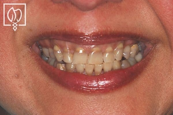 dental-crown-smile-makeovers-discolored-teeth-transformations-dental-crowns-severely-discolored-dentition--5843