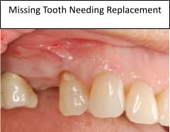 missing tooth replacement prosthodontist Bethesda