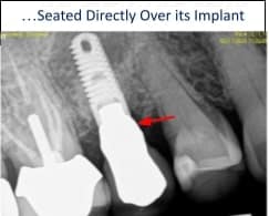 implant surgery before after Bethesda